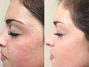 میکرونیدلینگ با استفاده از دستگاه مخصوص