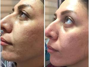 میکرونیدلینگ با استفاده از دستگاه مخصوص