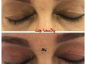 پلاسما جت