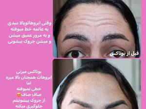 ارائه انواع خدمات مربوط به بوتاکس