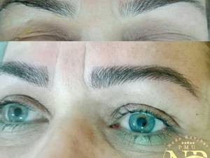 میکروبلیدینگ سبک فیبروز