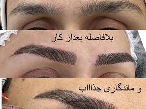 انجام فیبروز حرفه ای ابرو 