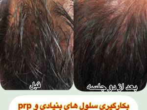 پی آر پی موی سر