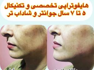 هایفوتراپی تخصصی صورت