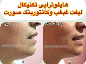 کانتورینگ صورت و لیفت غبغب