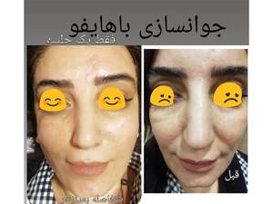 هایفوتراپی، جوانسازی دایم
