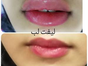 لیفت لب 
