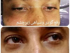 رفع گودی وسیاهی زیرچشم