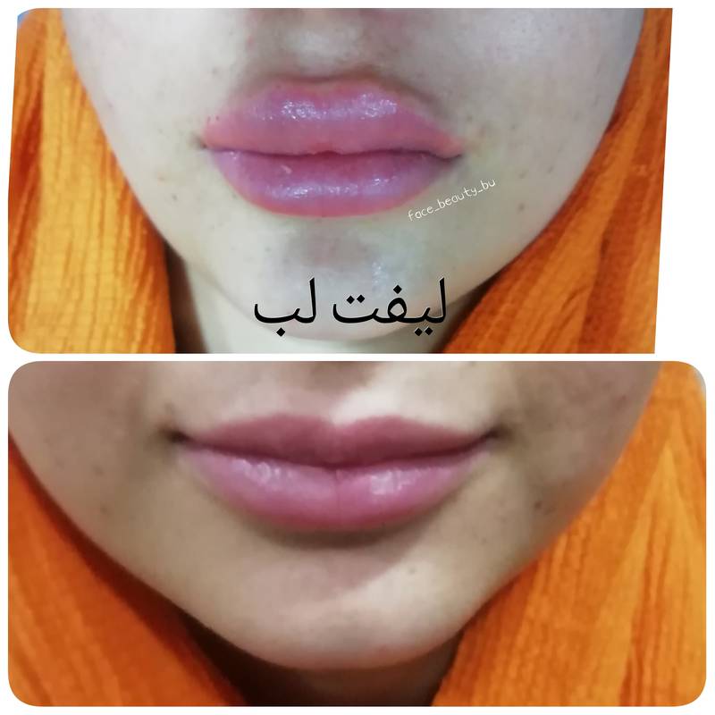 لیفت لب