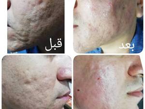 رفع اسکار جای جوش