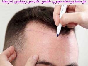 مشاوره کاشت مو و ابرو دائم و طبیعی